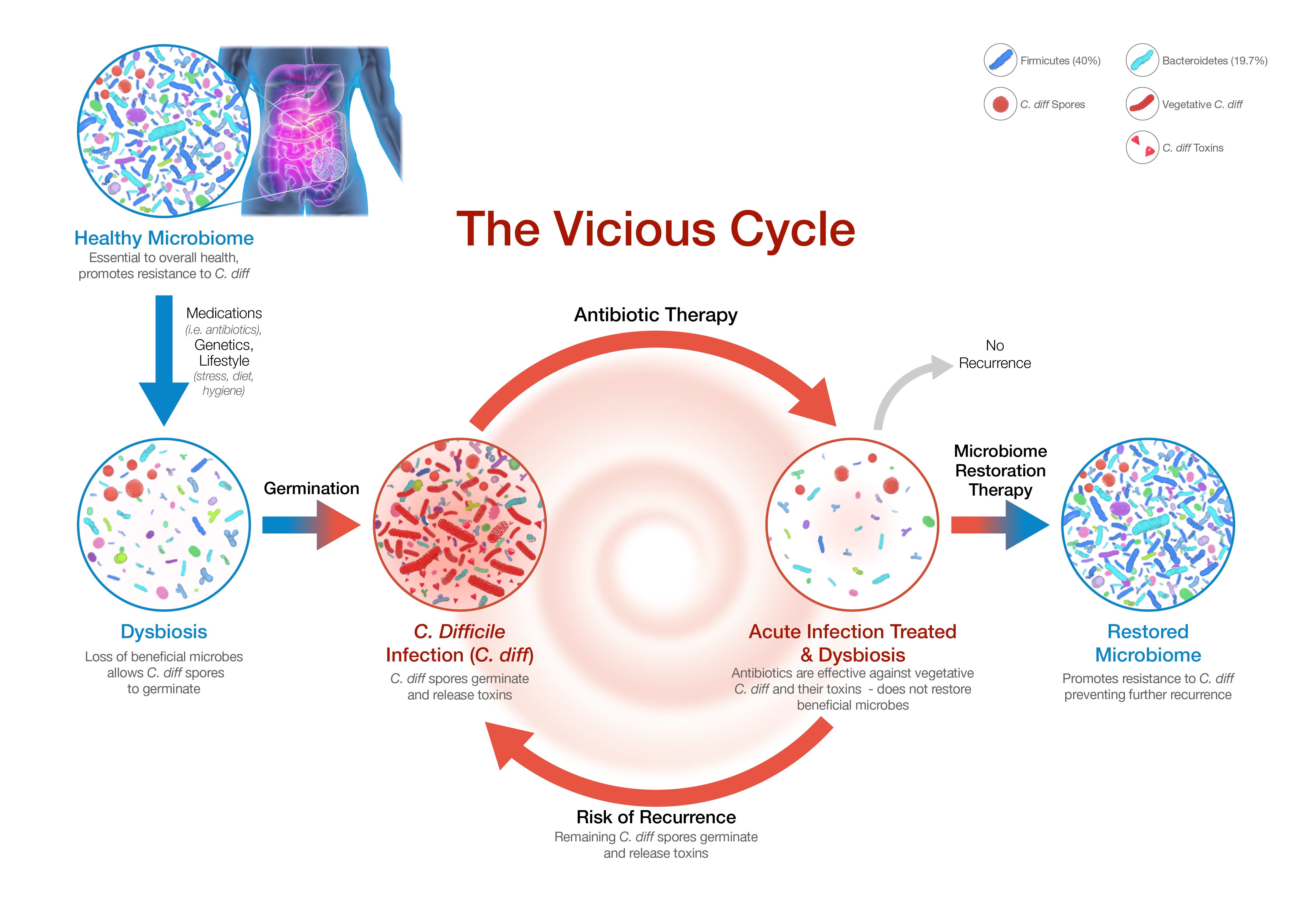 Cross-sections of gut microbiome depicting the pathophysiology of recurrent C. difficile infection (C. diff), with emphasis on the vicious cycle of recurrence.