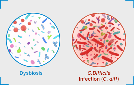 Magnified cross-sections of the gut microbiome in a dysbiotic state (left) and infected by C. difficile (right).